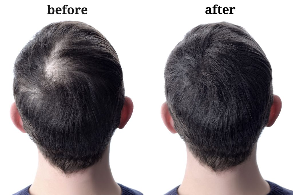 Exosome Therapy for Hair Loss: A Revolutionary Treatment | Dr Anastasia ...