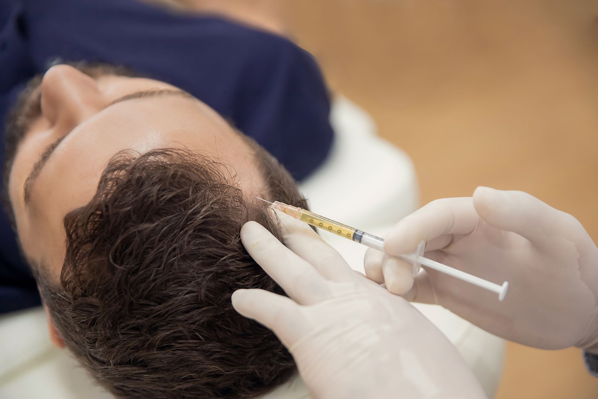 Non-surgical exosome therapy for hair restoration performed at Dr Therianou’s dermatology clinic in London.